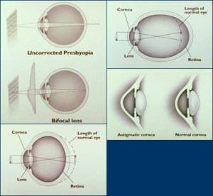what are refractive errors of vision and what causes them